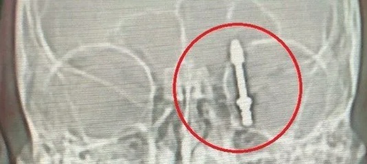 İmplant tedavisinde vida beynine saplandı: Yanlış tedavi hayatını kararttı